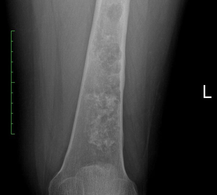 Conventional Chondrosarcoma: What Patients Should Know Now