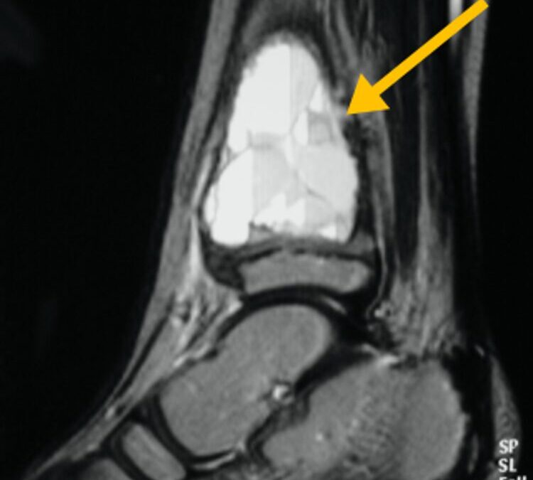 Aneurysmal BoneCyst: What is it Exactly and How to Treat It?