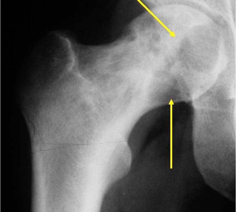 Basic Quick Facts You Should Know About Clear Cell Chondrosarcoma