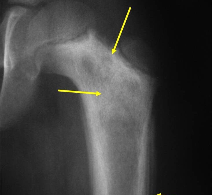 What You Need to Know About Ewing’s Sarcoma