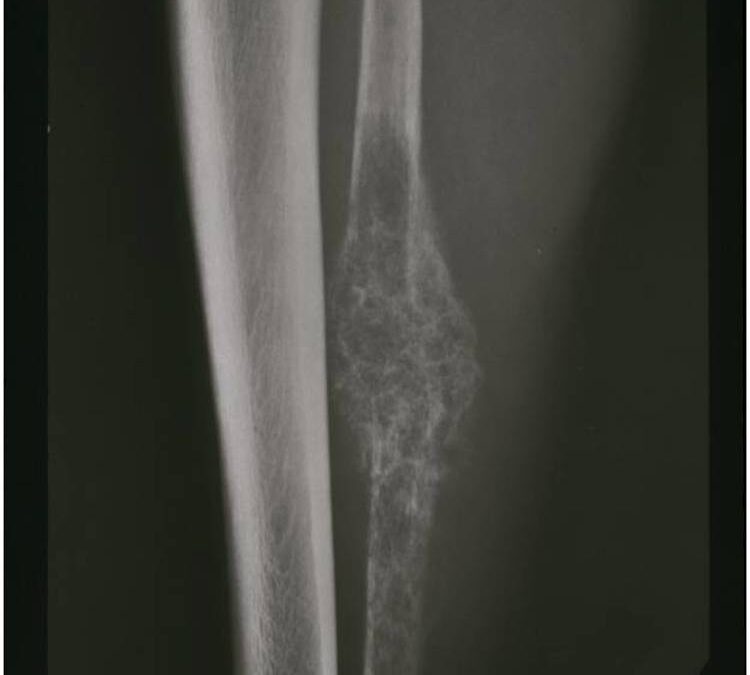 Mesenchymal Chondrosarcoma: What Are The Best Treatment Options for Patients?